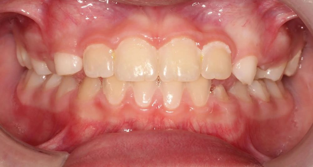 After treatment, front view