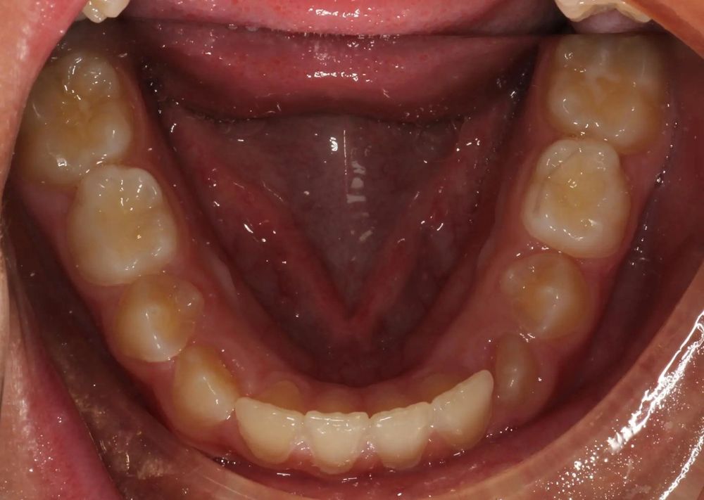 After treatment, lower teeth from above
