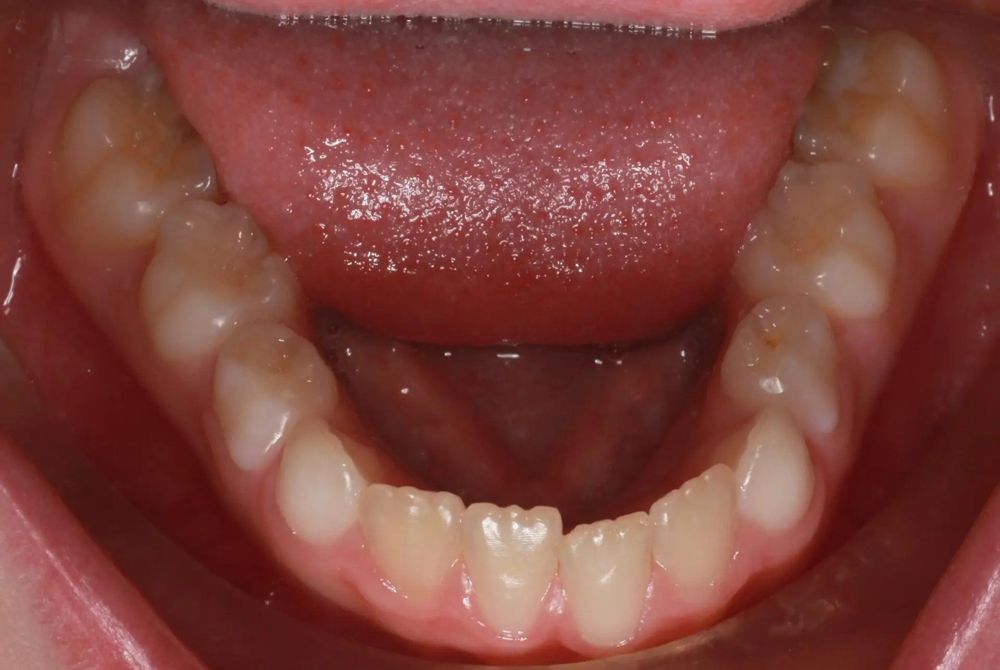 Before treatment, lower teeth from above