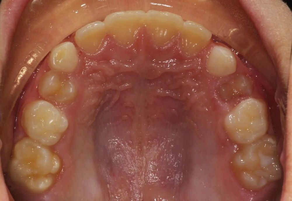 After treatment, upper teeth from above