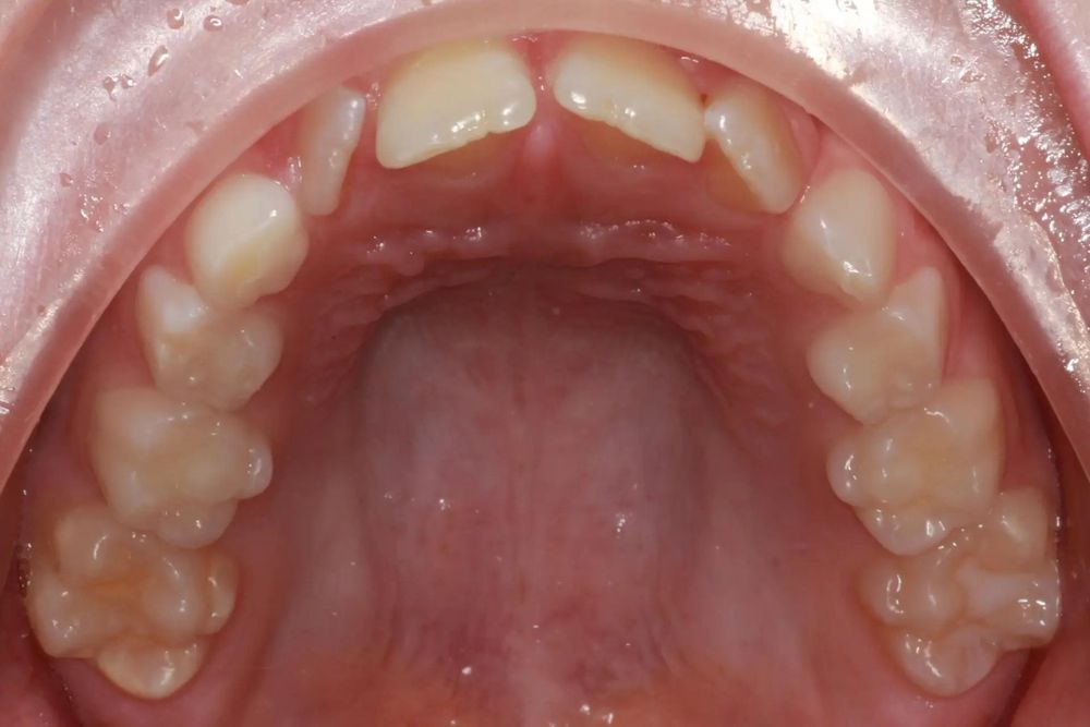 Before treatment, upper teeth from above