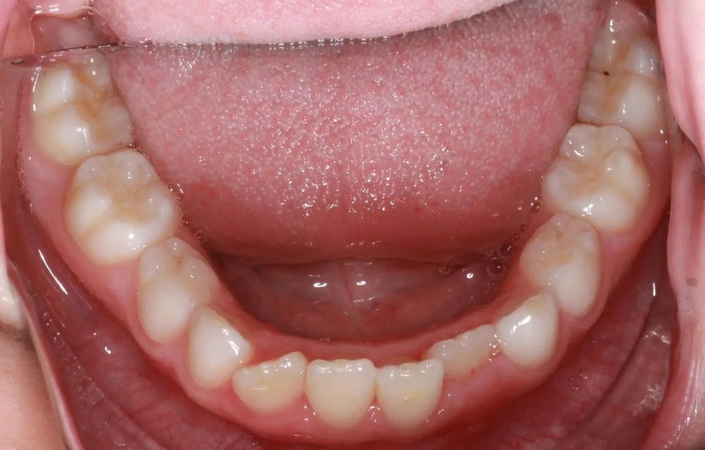 Before treatment, lower teeth from above