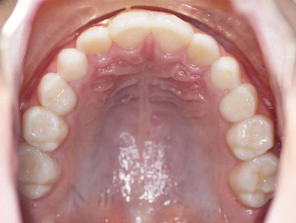 After treatment, upper teeth from above