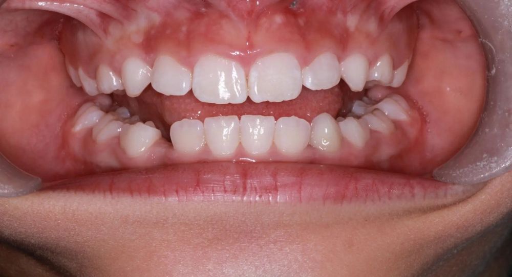 After treatment, front view