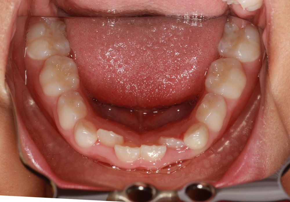 Before treatment, lower teeth from above