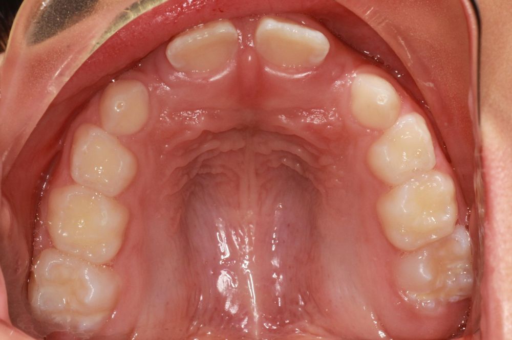 Before treatment, upper teeth from above