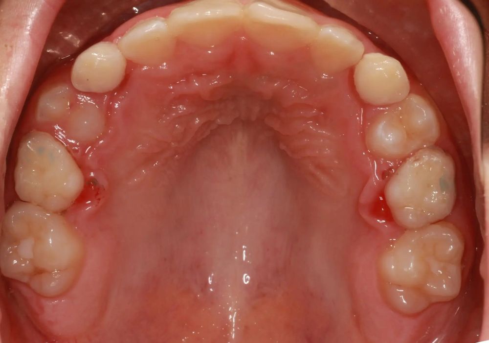 After treatment, upper teeth from above