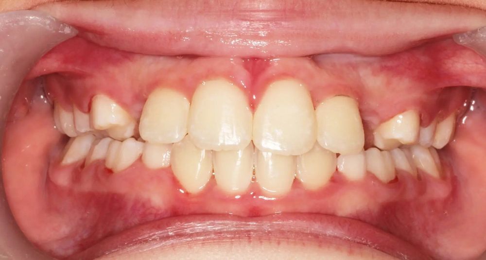 After treatment, front view
