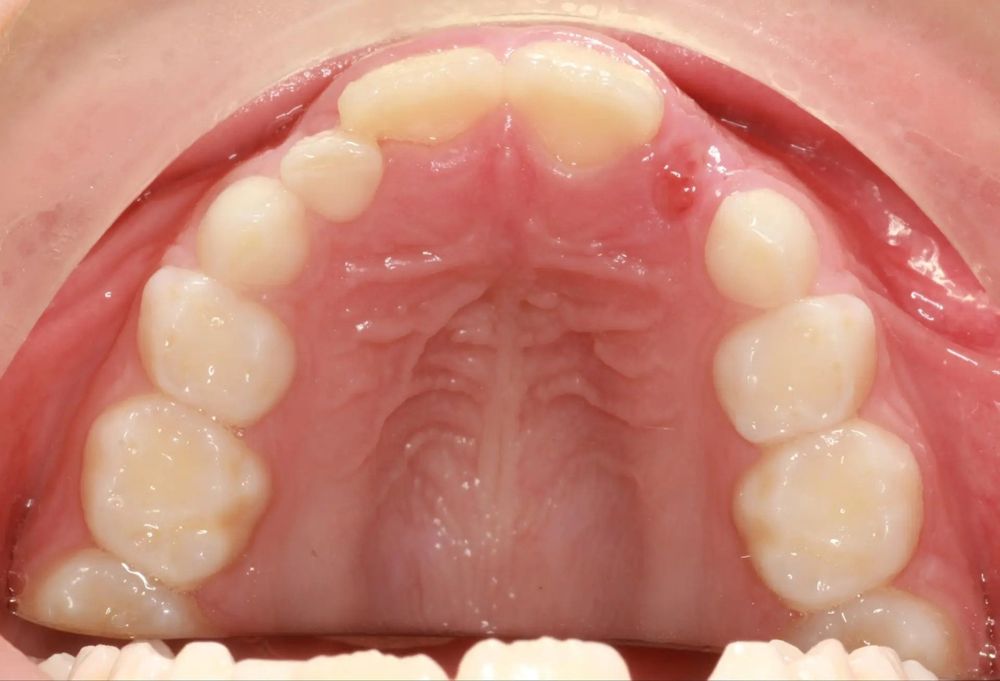 Before treatment, upper teeth from above