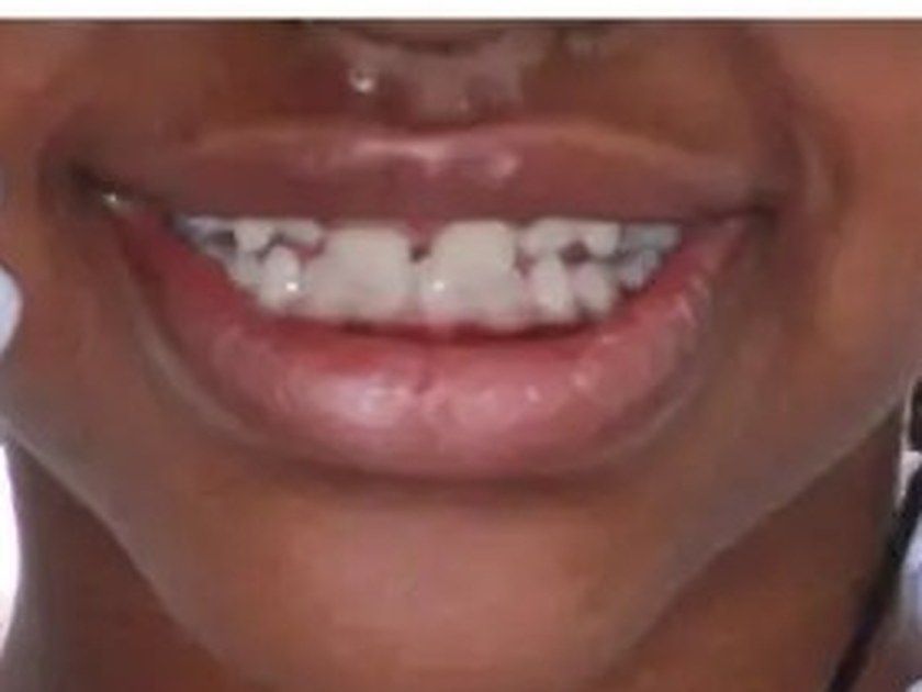 After treatment, close-up of the smile