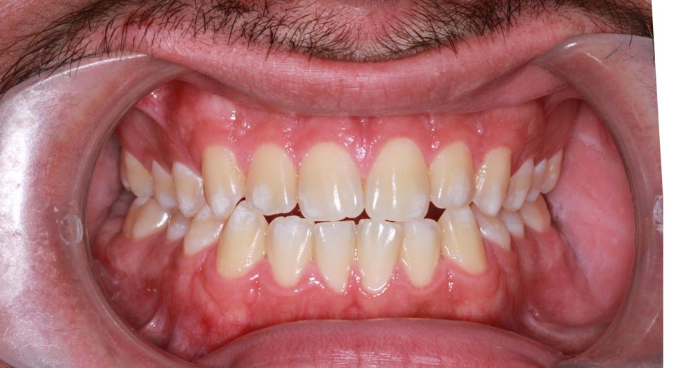 Before treatment, front view