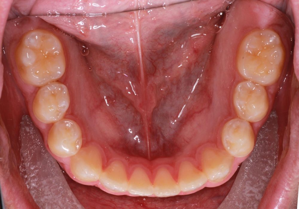 After treatment, lower teeth from above
