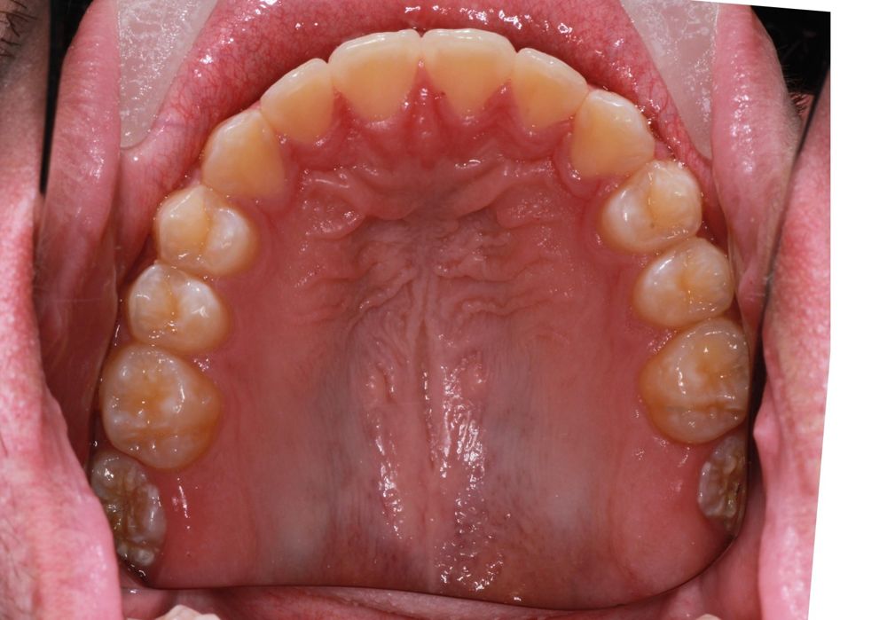After treatment, upper teeth from above