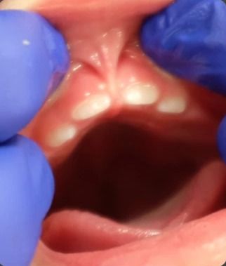 Example of an upper lip tie in a young child: the band of tissue under the upper lip attaches low, between the front teeth
