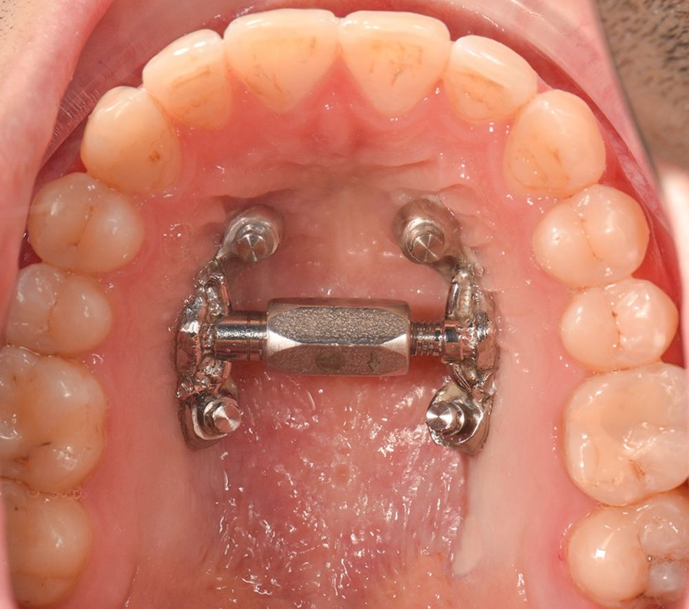 A MARPE expander in place on the palate