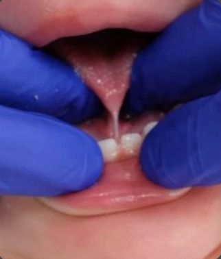 Example of a tongue tie in a young child: a short band of tissue holds the tip of the tongue down to the floor of the mouth